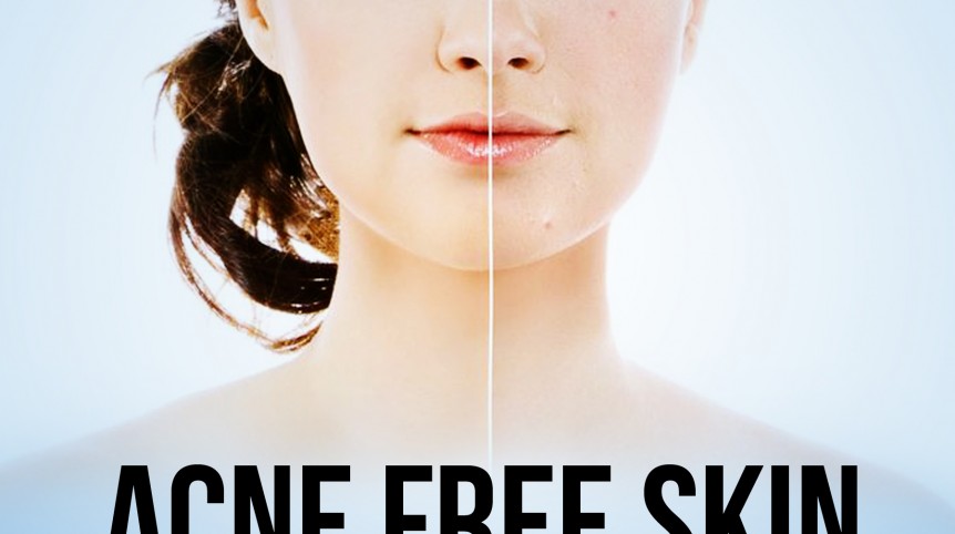 Acne Free Skin by Joyce Tibault